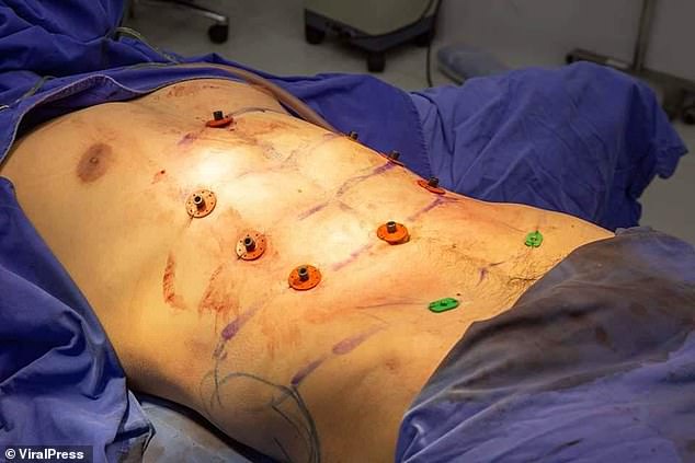 Another another image during the surgery shows him on on the operation table with objects in his torso