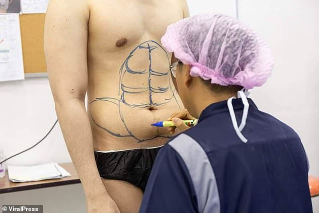 A photo ahead of the operation a photo shows the surgeon marking out individual abdomen muscles on his flat stomach